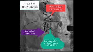 Tricuspid valve in valve implantation MyVal balloon expandable valve in Epic Bioprosthetic valve [upl. by Noirod133]