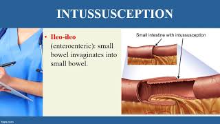 INTUSSUSCEPTION video [upl. by Dichy282]