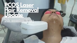 Laser hair removal face before and after 5th session  Hair growth and Laser burn update [upl. by Hahsia869]