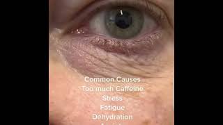 Blepharospasm shortvideoopthalmiceyesoptometristfactsstresscaffiene [upl. by Larrej]