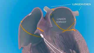 Herzrhythmusstörungen  das Vorhofflimmern [upl. by Nonek]