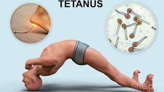 Tetanus Disease tetanusvaccine tetanus tetanusymptoms tetanusdiseaseinurdu [upl. by Duffy]