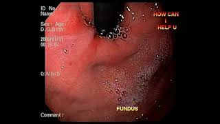 Duodenal polypEsophagitisduodenitis  endoscopy video [upl. by Atirihs429]