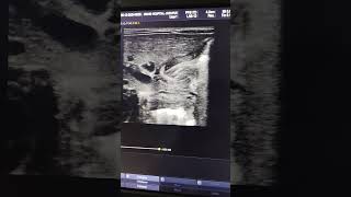 Congenital hypertrophic pyloric stenosis in neonates ultrasoundscans baby [upl. by Eidak484]