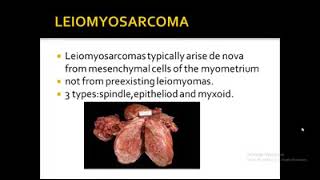 Leiomyoma and leiomyosarcoma of uterus Pathology Practical  Learning Pathology [upl. by Christoper]