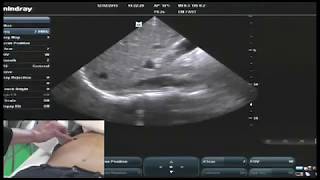 Hot Tips  IVC Volume Assessment with Ultrasound [upl. by Reivax439]