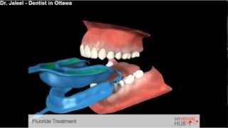 Preventive  Fluoride Treatment  Dentist Ottawa [upl. by Sam672]