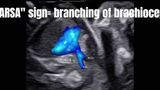 fetal right subclavian arterydemonstrating on ultrasound RSA fetalecho drnupurshah [upl. by Sharma804]