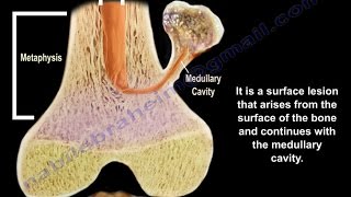 Osteochondroma  solitary and multiple  Everything You Need To Know  Dr Nabil Ebraheim [upl. by Lisk]