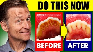 Natural Solution for Plaque Cavities and Gingivitis [upl. by Mutua705]