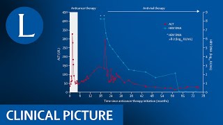 Hepatitis B reactivation after chemoimmunotherapy screen before treatment [upl. by Alliuqahs897]