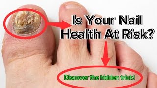 I Cured My Nail Fungus in 24 Hours Shocking Results [upl. by Emalia]