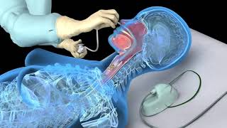 Nasotracheal suctioning NTS  3D animation [upl. by Eiffub]