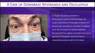 A Case of Downbeat Nystagmus and Oscillopsia [upl. by Rolyab]