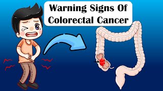 Warning Signs Of Colon Cancer  What Are The Early Signs amp Symptoms Of Colon Cancer [upl. by Alenas]