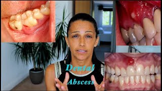 How to treat a Dental Abscess Different Natural Mouthrinses and their uses [upl. by Trimble]