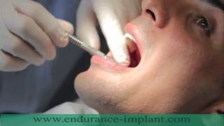 refaire toutes ses dents implant dentaire [upl. by Naot785]