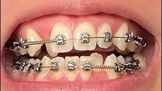 Adult Braces Time Lapse  8 Month Progression  Front View  Premolar Extraction  Moving Canine [upl. by Ahsiekal]