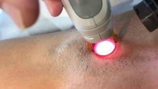 Epilation définitive des aisselles sur peau mate [upl. by Ruhl]