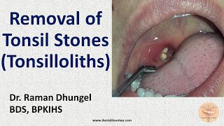 Tonsil Stone Removal  Tonsillolith removal by Dr Raman Dhungel [upl. by Roper]