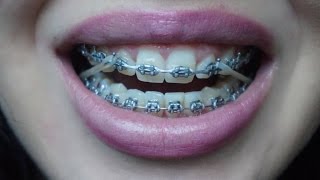 BracesOrtho update Closeup elastics gone wrong and more [upl. by Coyle]