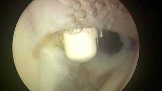 Shoulder Arthroscopy Dr Cascio Biceps tenodesis 2 of 2 [upl. by Haropizt529]