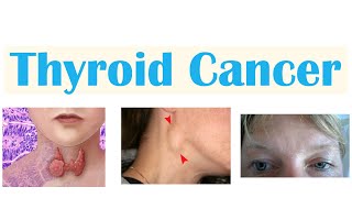 Thyroid Cancer Papillary Follicular Medullary amp Anaplastic  Symptoms Diagnosis Treatment [upl. by Akieluz158]