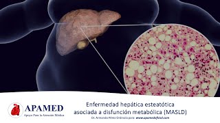 Esteatosis hepática asociada a disfunción metabólica MASLD NAFLD [upl. by Der]