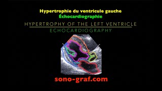 Échocardiographie  Hypertrophie du ventricule gauche [upl. by Notaes618]