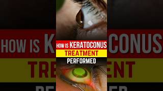 How is Keratoconus Treatment Done  Keratoconus Treatment Explained [upl. by Dnalsor]