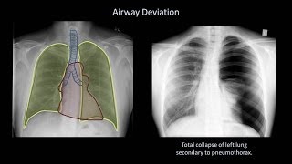 How to Interpret a Chest XRay Lesson 4  Airways Bones and Soft Tissues [upl. by Namrehs]