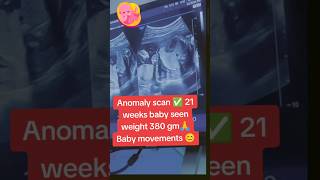 Anomaly scan done 21 weeks baby seen weight 380 gm🙏viralvideo trending viralshorts [upl. by Mazurek328]