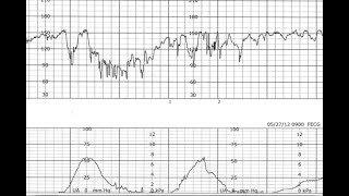 Fetal Monitoring Segment 4 Fetal Heart Decelerations [upl. by Sucerdor]