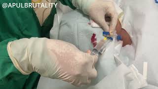 Right internal jugular central venous catheter CVC  CV line  vena dalam [upl. by Nnylaehs]