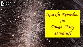 FLAKY SCALP DANDRUFF not cleared by Home Remedies What to do  Dr Amee Daxini  Doctors Circle [upl. by Ecnaled]