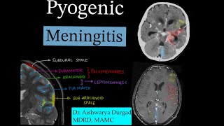 Pyogenic meningitis discussion Leptomeningeal enhancementDifferential diagnosis [upl. by Niatsirk565]