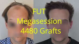 FUT hair transplant Before And After Result 4480 Megasession [upl. by Cinemod]