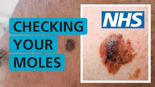 How do I check if my mole is skin cancer  NHS [upl. by Gypsie]