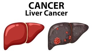 LIVER CANCER BSC NURSINGdailypost [upl. by Enirak]