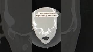 Cholesteatoma with Mastoiditis CT Temporal Bones [upl. by Callan]