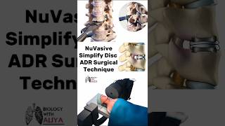 NuVasive  Simplify Disc  ADR Surgical Technique medical animation 3d short [upl. by Harat264]