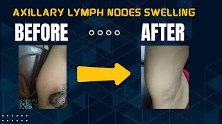 Case of Axillary lymph nodes swelling [upl. by Asital8]