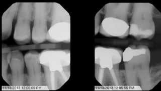 Tips and Tricks for Bitewing XRays [upl. by Iphagenia667]