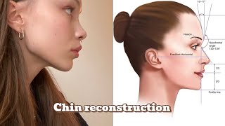 Chin reconstruction Forward pulled fully grown chin Subliminal [upl. by Akcired]