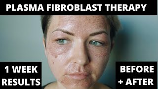 PLASMA PEN FIBROBLAST THERAPY PROCESS  1 WEEK RESULTS BEFORE amp AFTER  SKIN TIGHTENING [upl. by Eyoj]