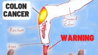 4 Warning Signs of Colon Cancer You Should NEVER Ignore [upl. by Urana]