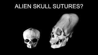 Science VS the Aliens of Peru Episode 4 Skull sutures and parietal foramen [upl. by Mailiw545]