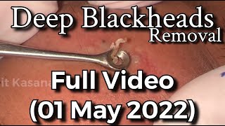 Deep Blackheads Removal with Cotton Bud amp Extractor Full Video By DrLalit Kasana [upl. by Meredeth]