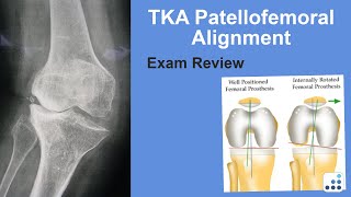 TKA Patellofemoral Alignment Exam Review  Ron Delanois MD [upl. by Melbourne]