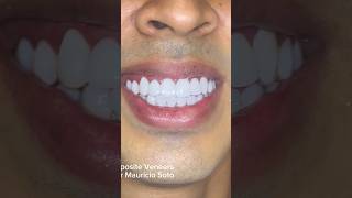 Composite Veneers 3 Hours Smile Makeover By Dr Mauricio Soto [upl. by Atilrak]